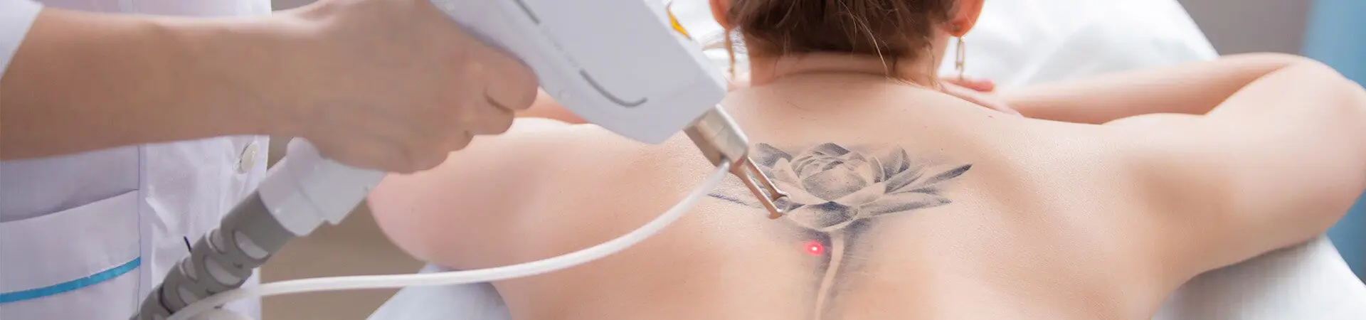 Tattooentfernung Düsseldorf
