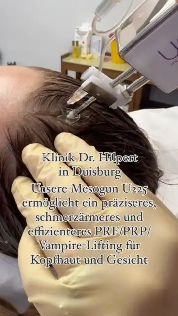 Schonendes PRF/PRP/Vampire-Lifting für Kopfhaut und Gesicht kann durch den Einsatz der Mesogun U225 effektiver gestaltet werden. Die Mesogun U225 ist ein hochpräzises Gerät, das minimalinvasive Injektionen ermöglicht und so die Behandlung angenehmer und präziser macht.Hier sind einige Vorteile der Verwendung der Mesogun U225 für PRF/PRP/Vampire-Lifting:1. Präzision: Die Mesogun U225 ermöglicht exakte Injektionen in die gewünschten Hautschichten, was die Effektivität der Behandlung erhöht.
2. Schmerzreduktion: Durch die feine Nadel und die präzise Steuerung der Injektionstiefe wird das Verfahren weniger schmerzhaft und damit komfortabler für den Patienten.
3. Konstanter Fluss: Die Mesogun sorgt für eine gleichmäßige Verteilung des injizierten Materials, was zu besseren Ergebnissen führen kann.
4. Zeiteffizienz: Das Verfahren kann schneller durchgeführt werden, was sowohl für den Patienten als auch für den Behandler vorteilhaft ist.
5. Minimale Downtime: Die schonende Technik führt zu weniger Blutergüssen und Schwellungen, was die Erholungszeit für den Patienten minimiert.Durch diese Vorteile bietet die Mesogun U225 eine verbesserte Methode für PRF/PRP/Vampire-Lifting-Behandlungen, indem sie die Präzision, den Komfort und die Effizienz der Verfahren erheblich steigert. #plastischechirurgie #haarausfall #prf #prp #duisburg
