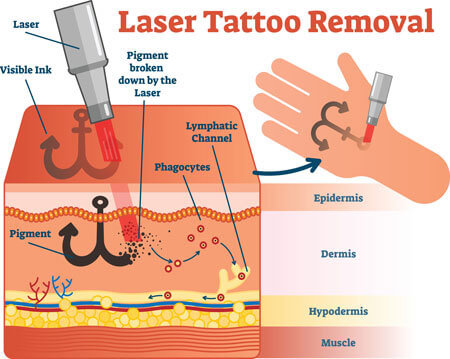 Tattooentfernung Laser