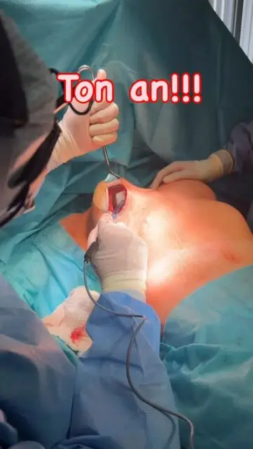 In Brasilien voroperierte Patientin mit zu hohen und großen Implantaten. Beim Implantattausch wird die Kapsel elektrothermisch ⚡️durch die sogenannte „Popkorntechnik“ gerafft. Woher der Name stammt erklärt sich beim Zuhören von selbst🍿👂🏻🤗