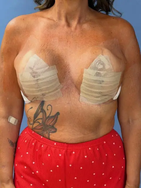 Gestern hatten wir Bilder von der Implantatentfernung mit anschließender Straffung gezeigt. Hier ist nun das Ergebnis einen Tag postoperativ. Die Brust wird sich jetzt noch setzen und eine natürliche Form bekommen. Trotz der Implantatentfernung ist der Patientin noch ausreichend Volumen vorhanden. Die Patientin hat der Veröffentlichung der Bilder, trotz erkennbarer Tätowierung, ausdrücklich zugestimmt. Auch um anderen Frauen den Mut zu diesem Schritt zu machen. Vielen Dank dafür🙏🏻
@klinik_dr_hilpert #implantatentfernung #brustvergrösserung #plastischechirurgie #duesseldorf #duisburg
